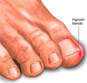 3 common foot conditions – diagnosis and treatment - Silversurfers